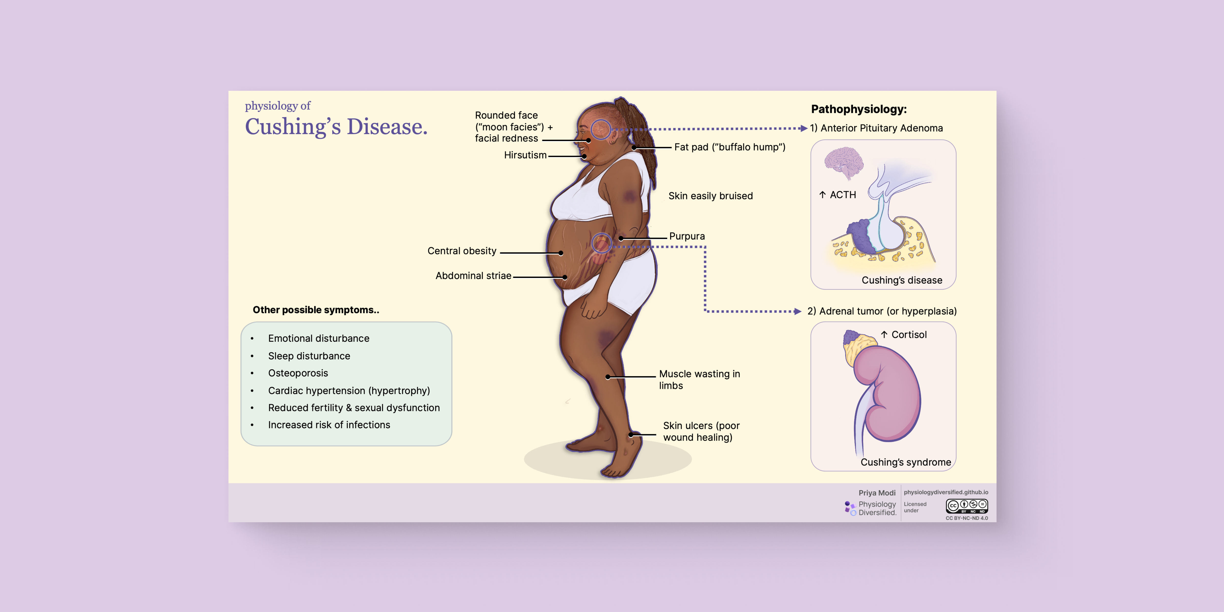Cushing’s Disease