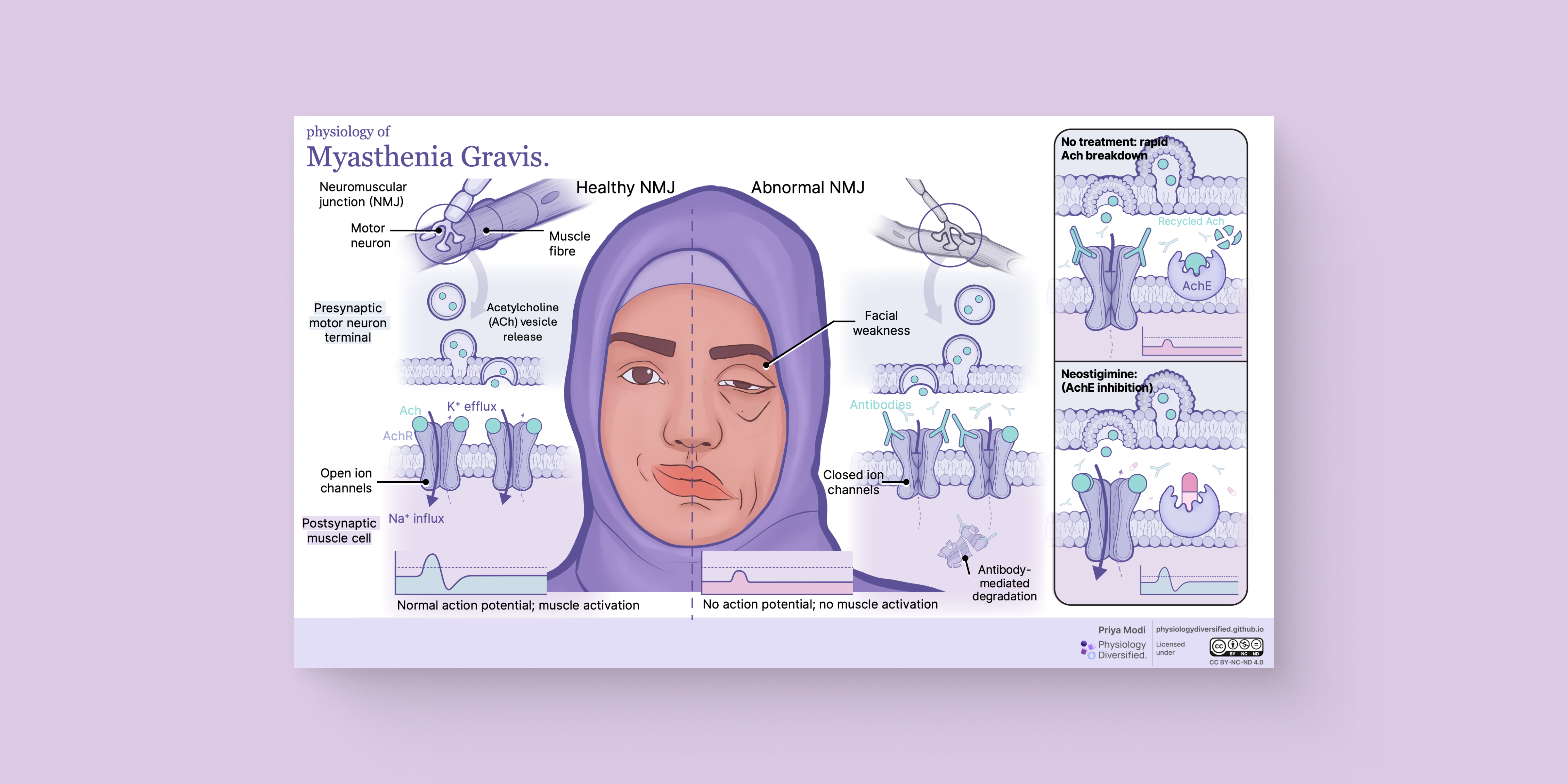 Myasthenia Gravis